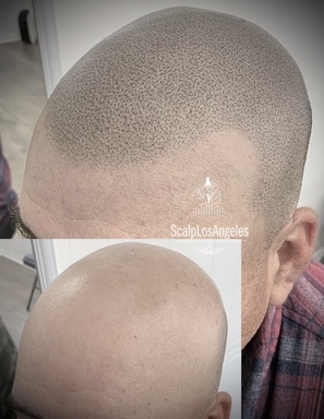 Scalp Micropigmentation aka Hair Tattoo