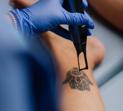 Laser Tattoo Removal Reclaim Your Natural Skin